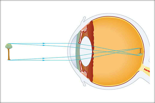 hipermetropia unui ochi